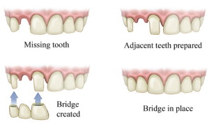 Dental-Bridge