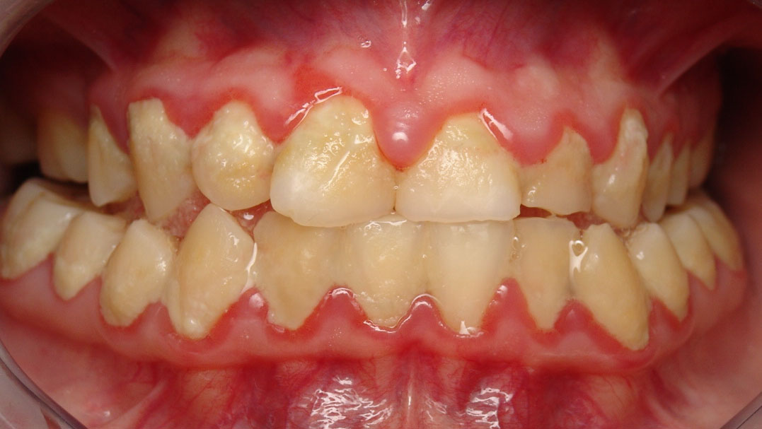 yellow around teeth calculus